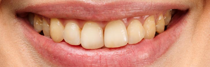 caso de ortodoncia antes del tratamiento en Dental Terán Hermosillo