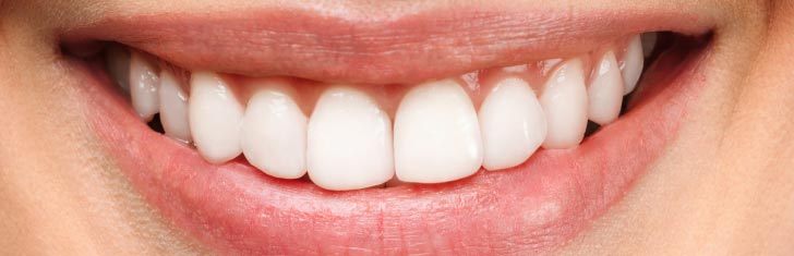 resultado de tratamiento de ortodoncia en Dental Terán, sonrisa después del tratamiento